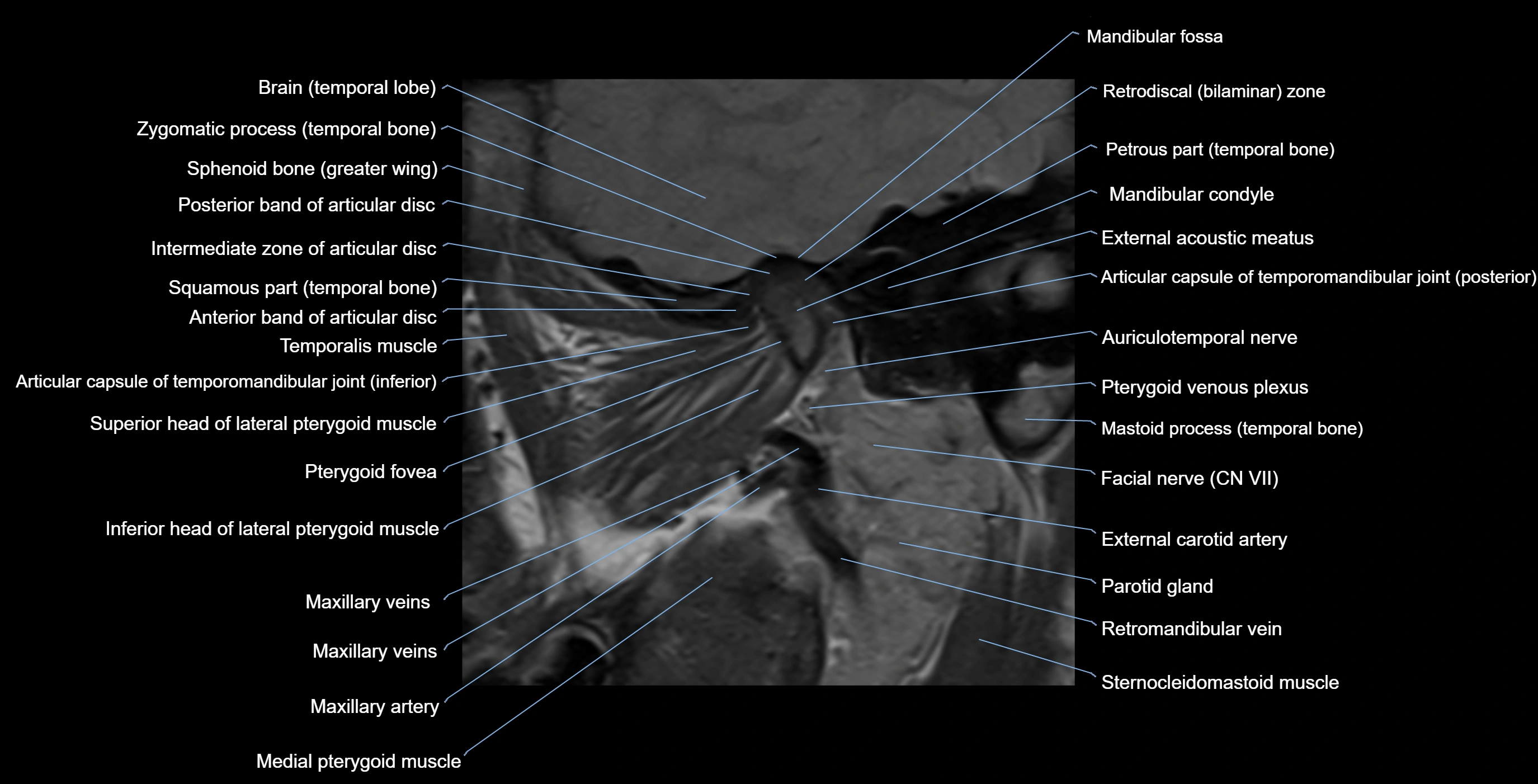 MRI TMJ sagittalclosed  mouth cross sectional 3T anatomy -img-00001-00010.webp